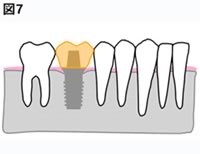 インプラント治療イメージ