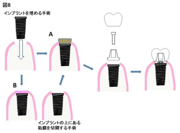 インプラント治療イメージ