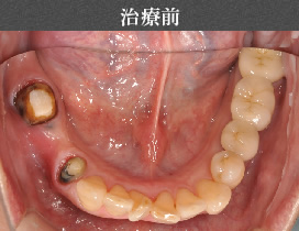 インプラント治療前